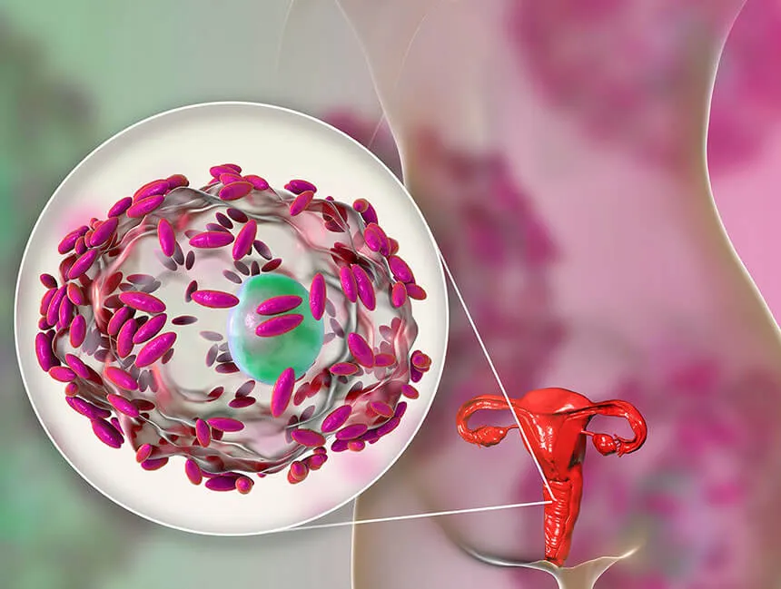 Bakterijska vaginoza — neravnovesje bakterij v nožnici